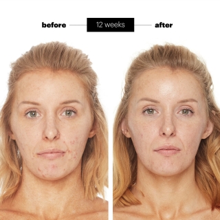 Adapalene Gel 0.1% Acne Treatment 2