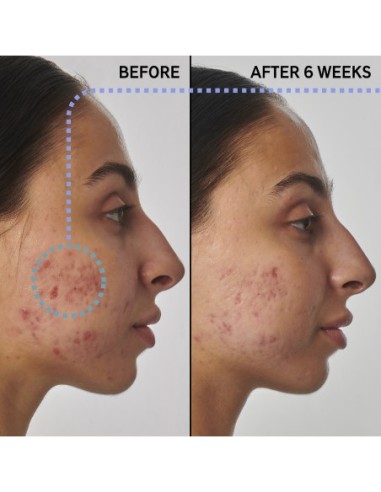 SuperSolutions 1% Retinol Serum